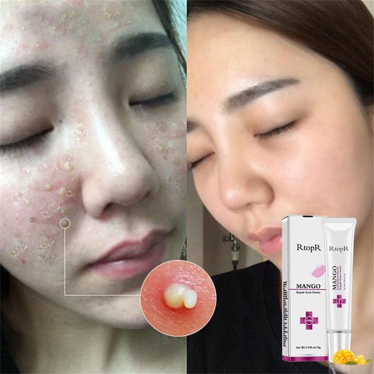 Anti-acne Facial Skin - MIM'S Kollectionz