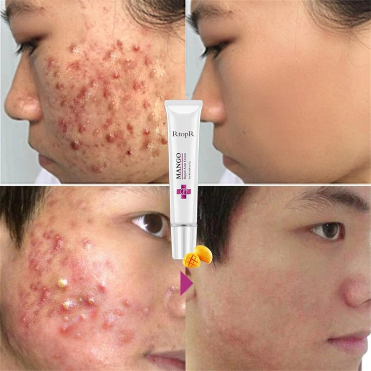 Anti-acne Facial Skin - MIM'S Kollectionz